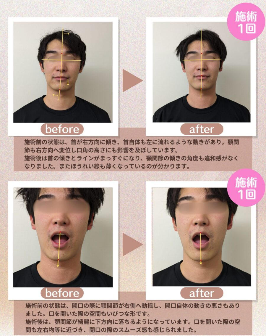 小顔矯正ビフォーアフター画像２