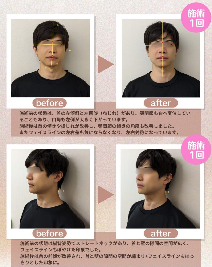小顔矯正ビフォーアフター画像３