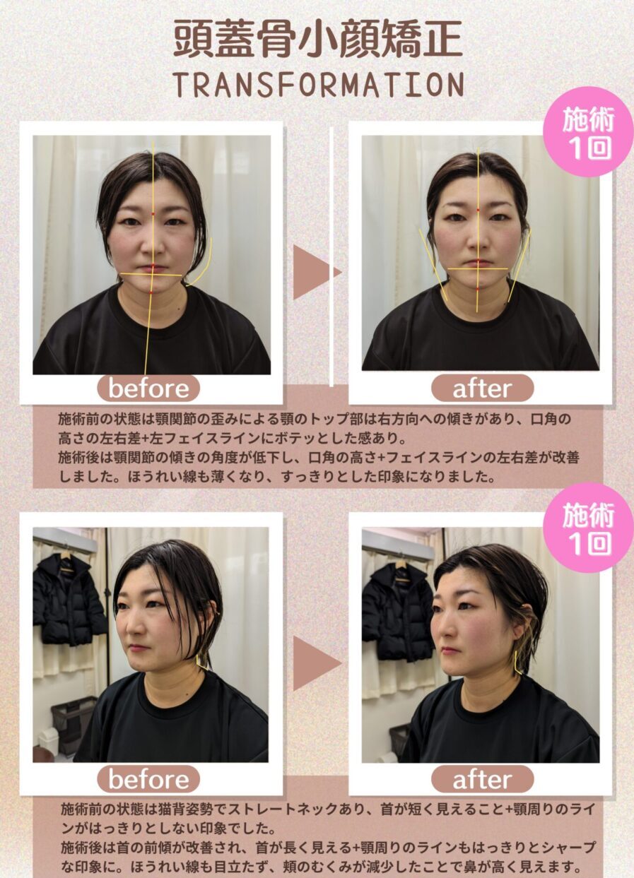 小顔矯正ビフォーアフター画像１