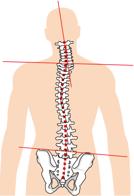 腰痛の原因解説図|骨盤・背骨の歪みによる負担メカニズム