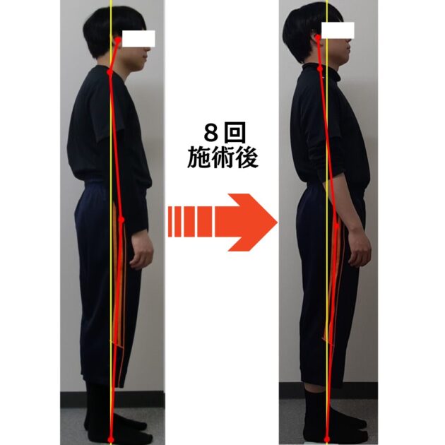 姿勢矯正8回後のビフォーアフター写真。猫背が改善した比較画像