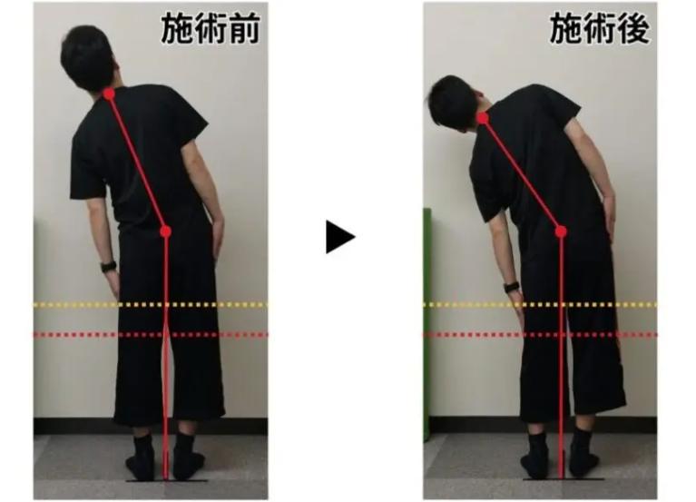 整体前と整体後の側屈の変化