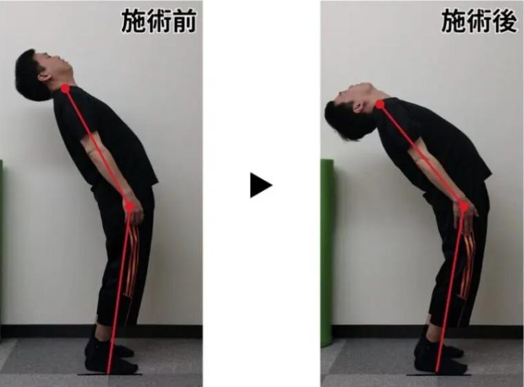 整体前と整体後の後屈の変化