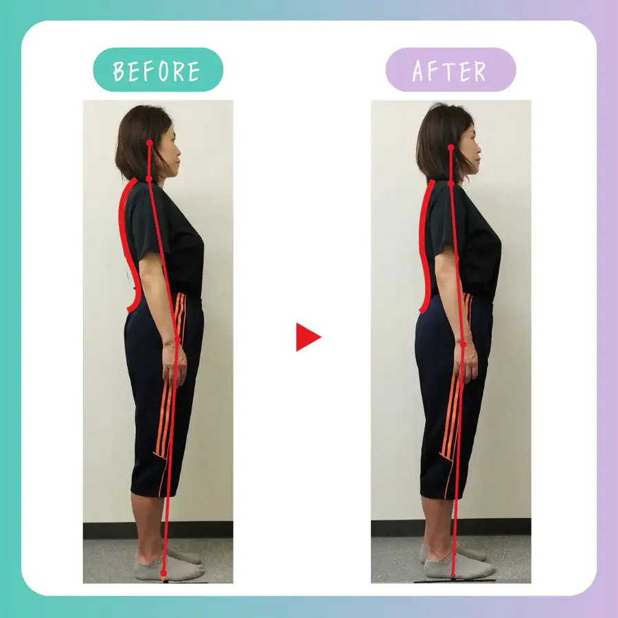 猫背・反り腰のビフォーアフター。整体施術で姿勢が整い、立ち姿が自然に変化。