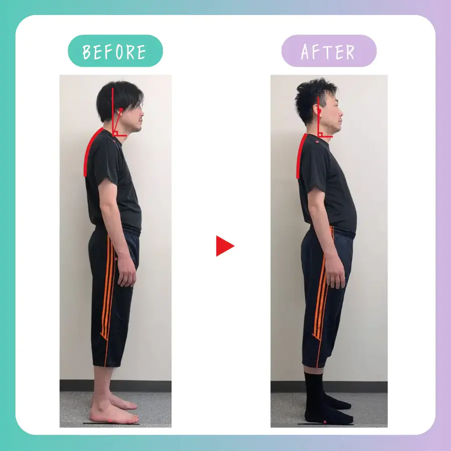 男性の姿勢改善のビフォーアフター画像。施術により肩の位置・背骨のカーブ・重心が整っている。
