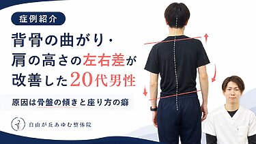 【症例紹介】背骨の曲がり・肩の高さの左右差が改善した20代男性