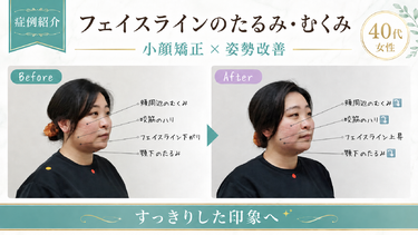 【症例紹介】フェイスラインのたるみ・むくみが改善した40代女性｜小顔矯正×姿勢改善【自由が丘】