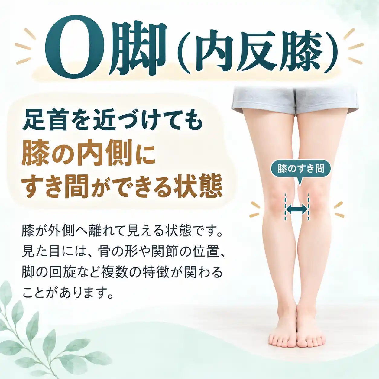 O脚（内反膝）の特徴を説明する図解。足首を近づけても膝の内側にすき間ができる脚の状態を写真で示し、骨の形や関節の位置、脚の回旋などが関係することを解説。