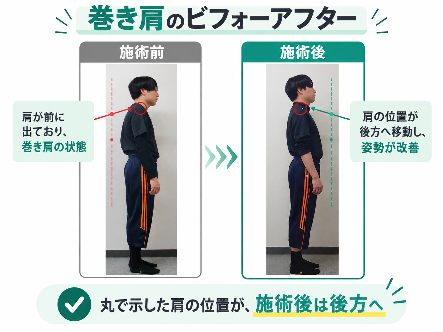 巻き肩の施術前後を横向きの写真で比較した画像。施術前は肩が前に出た姿勢で、施術後は肩の位置が後方へ移動した様子を赤と緑の補助線や丸印で示している。