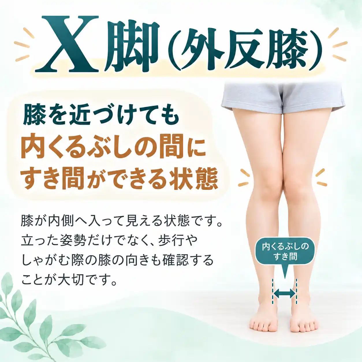 X脚（外反膝）の特徴を説明する図解。膝を近づけても内くるぶしの間にすき間ができる脚の状態を写真で示し、立った姿勢だけでなく、歩行やしゃがむ際の膝の向きも確認することの重要性を解説。